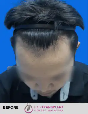 hair Transplant