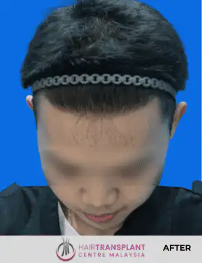 hair Transplant