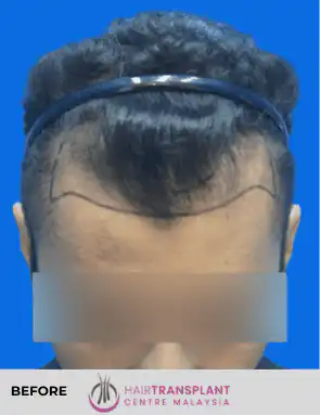 hair Transplant