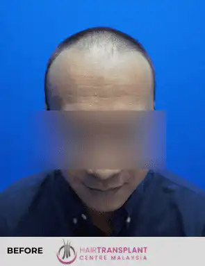 hair Transplant