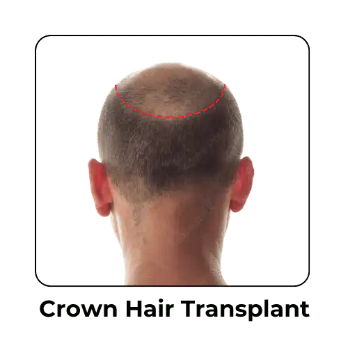 Crown Hair Transplant in Malaysia