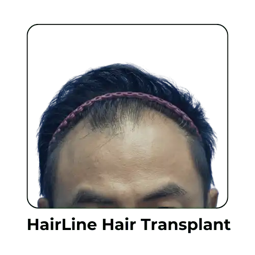 HaihairLine Hair Transplant in Malaysia