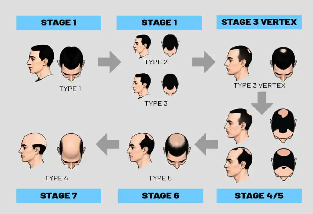 Hair Transplant Malaysian - Hair loss Steps