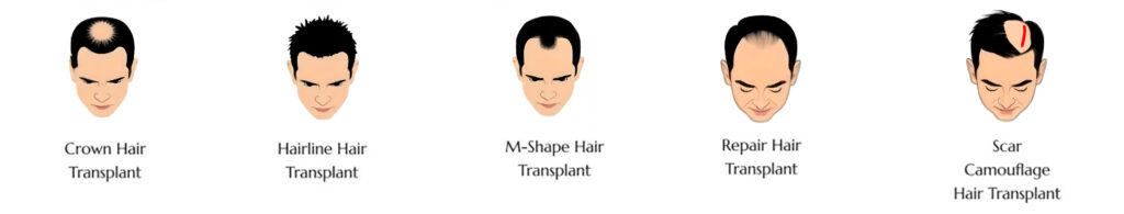 Hair Transplant in Malaysia