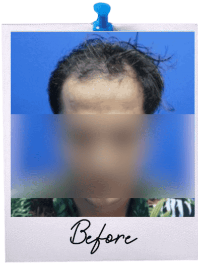 Hair Transplant in Malaysia - Before 7 2025