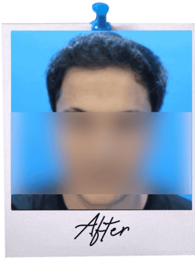 Hair Transplant in Malaysia - After 5 2025