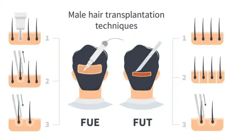 FUE hair transplant Malaysia