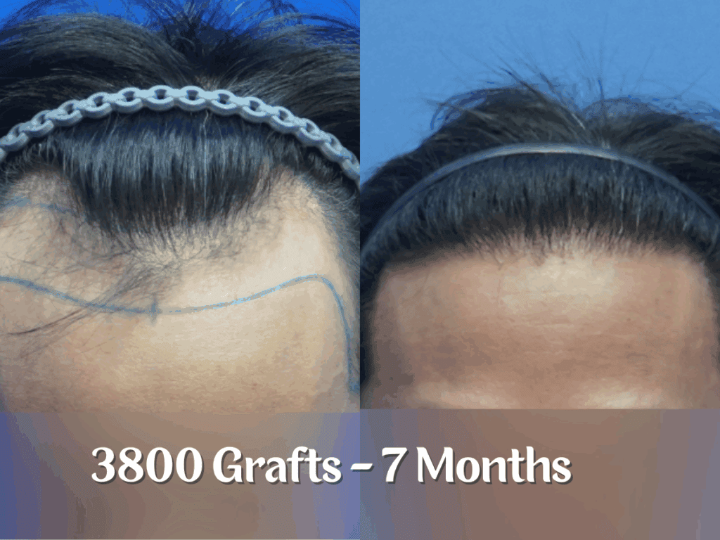 3800 Grafts - 7 Months