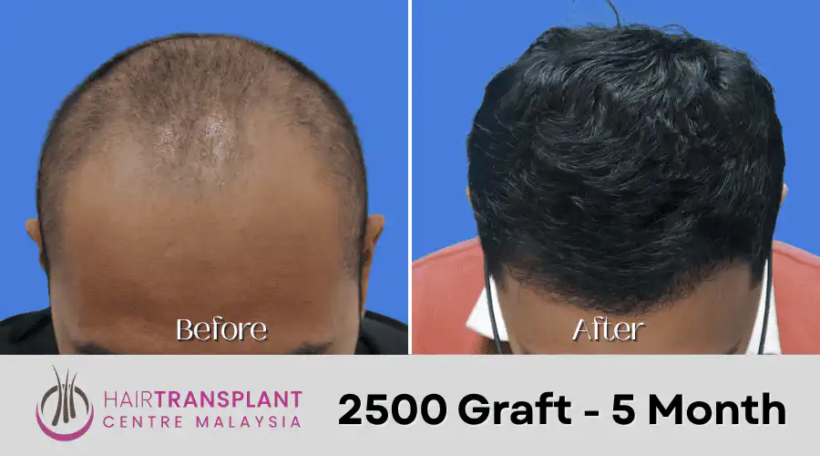 Hair Transplant Malaysia - 2500 Graft - 5 Month