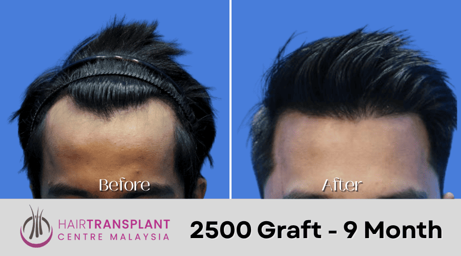 Hair Transplant Malaysia - Hair Transplant Result-2500 Graft - 9 Month