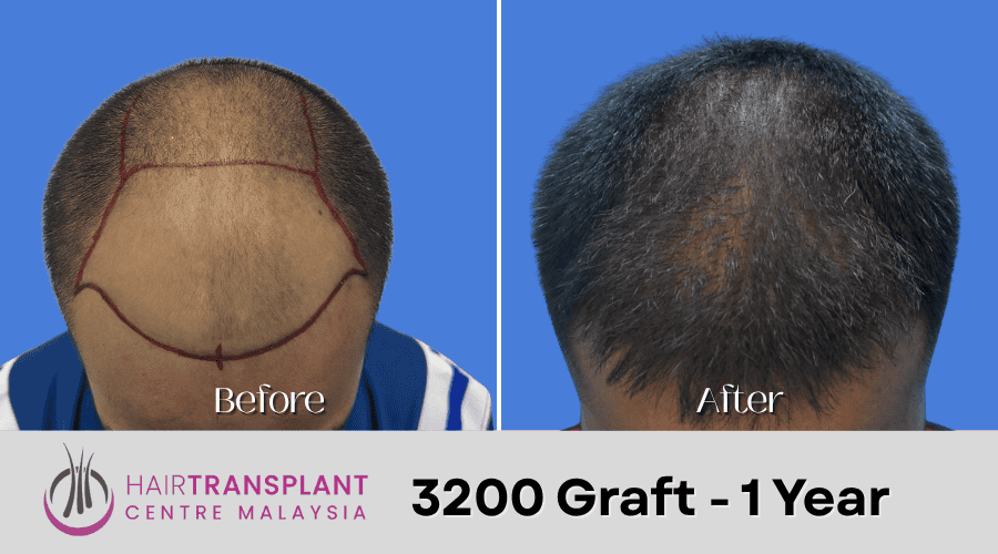 Hair Transplant Malaysia - 3200 Graft - 1 Year