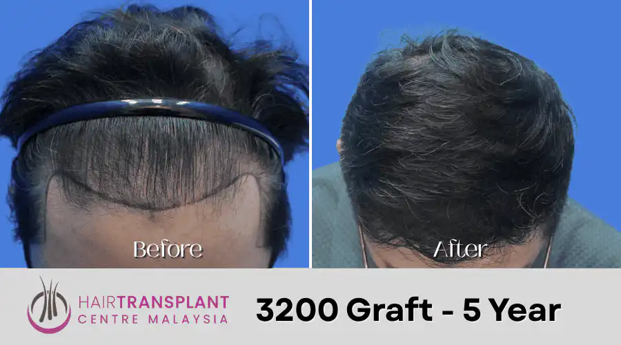 Hair Transplant Malaysia - 3200 Graft - 5 Year