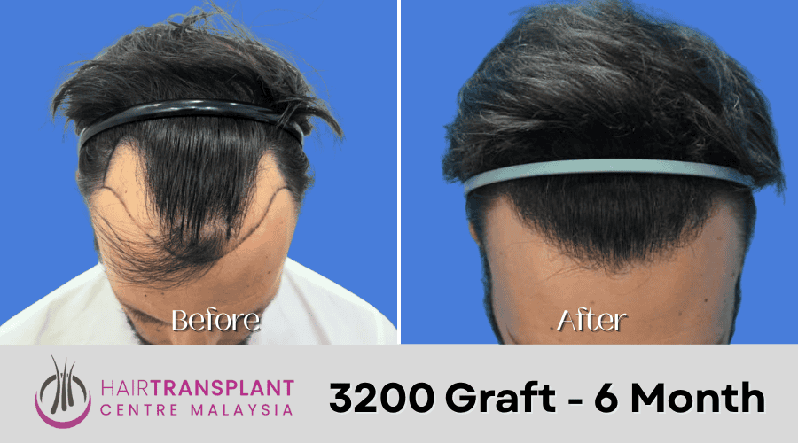 Hair Transplant Malaysia - 3200 Graft - 6 Month