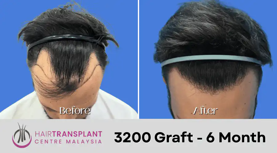 Hair Transplant Malaysia - 3200 Graft - 6 Month