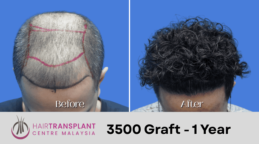 Hair Transplant Malaysia - 3500 Graft - 1 Year