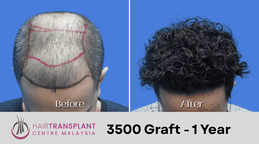 Hair Transplant Malaysia - 3500 Graft - 1 Year