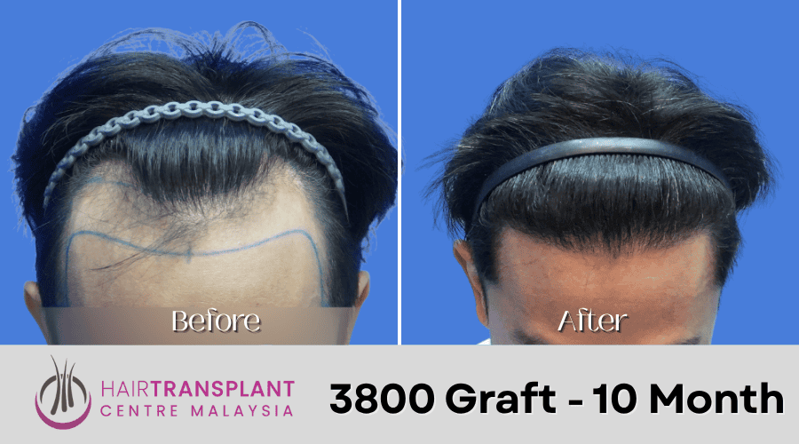 Hair Transplant Malaysia - 3800 Graft - 10 Month
