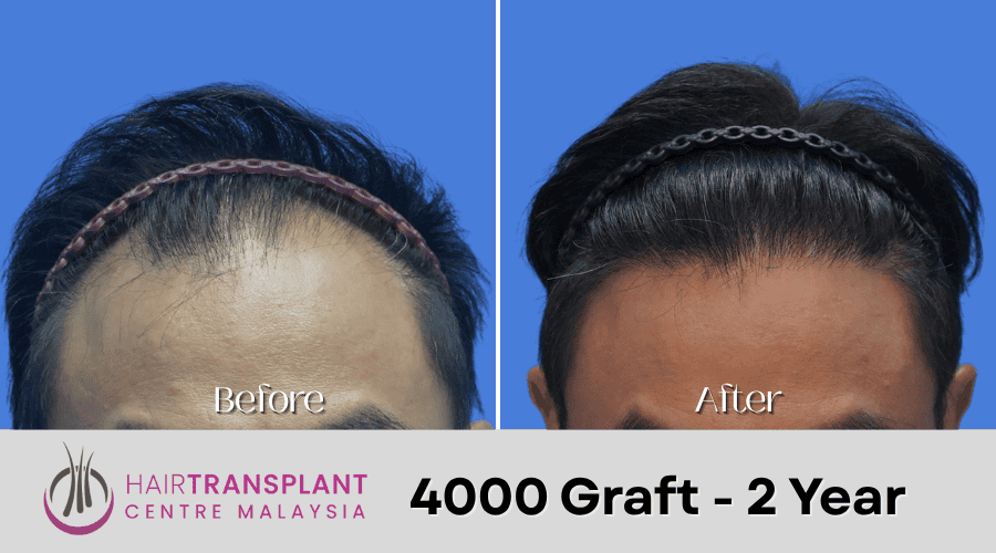 Hair Transplant Malaysia - 4000 Graft - 2 Year