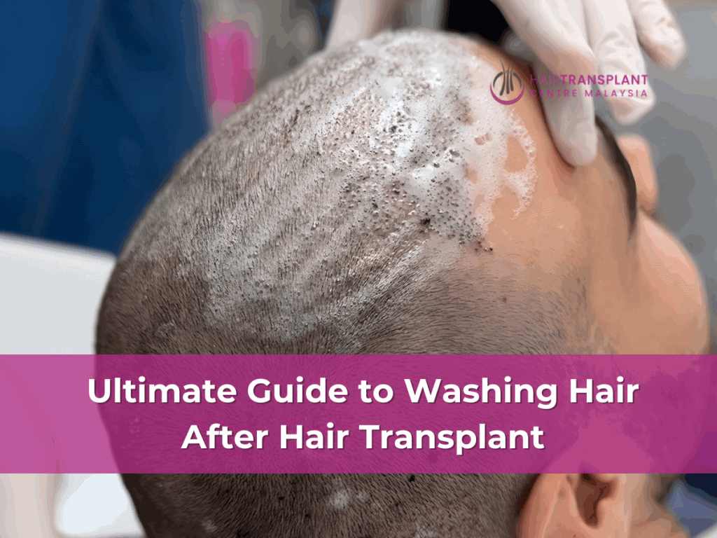 Ultimate Guide to Washing Hair After Hair Transplant