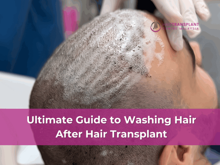 Ultimate Guide to Washing Hair After Hair Transplant