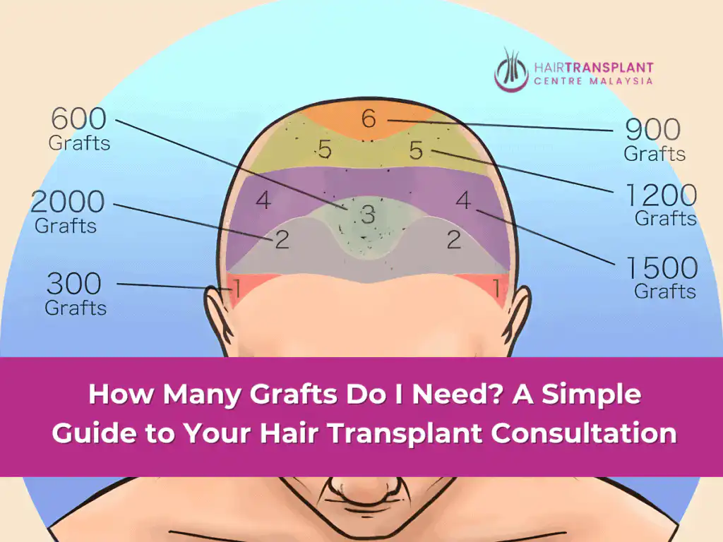 How Many Grafts Do I Need A Simple Guide to Your Hair Transplant Consultation