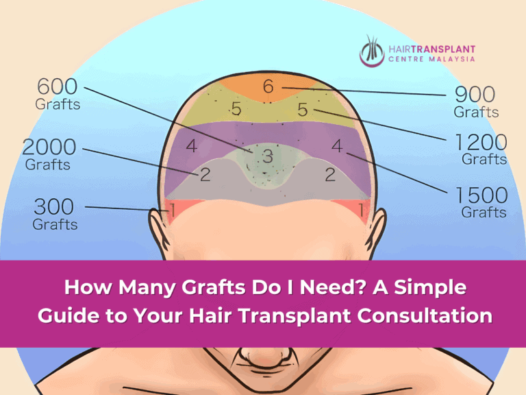 How Many Grafts Do I Need A Simple Guide to Your Hair Transplant Consultation