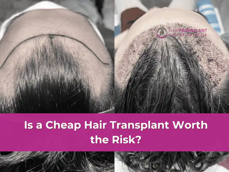 Is a Cheap Hair Transplant Worth the Risk?