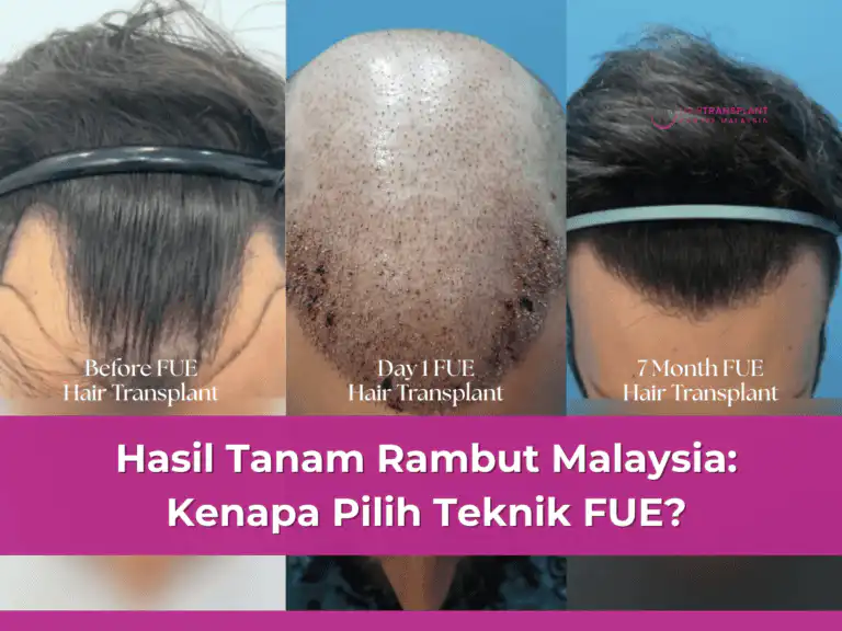 Hasil Tanam Rambut Malaysia Kenapa Pilih Teknik FUE