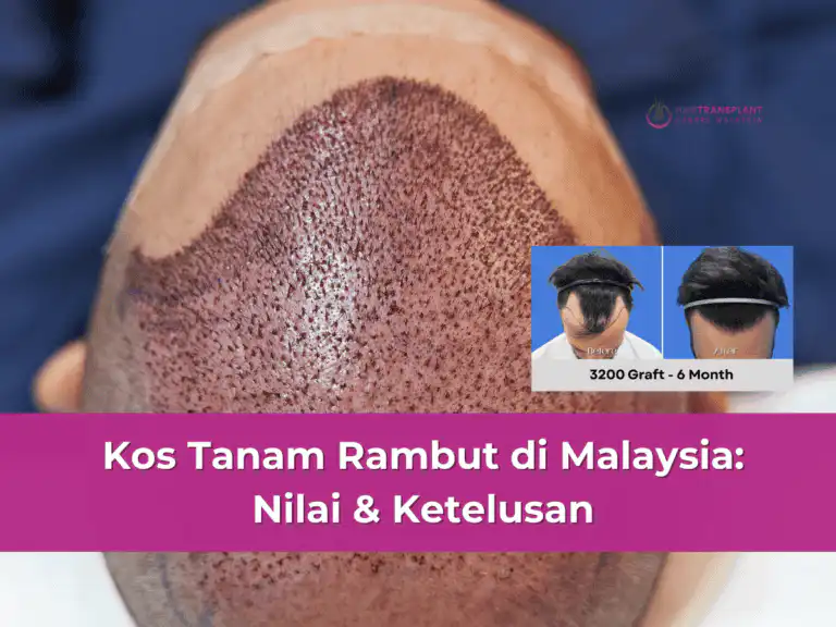 Kos Tanam Rambut di Malaysia: Nilai & Ketelusan