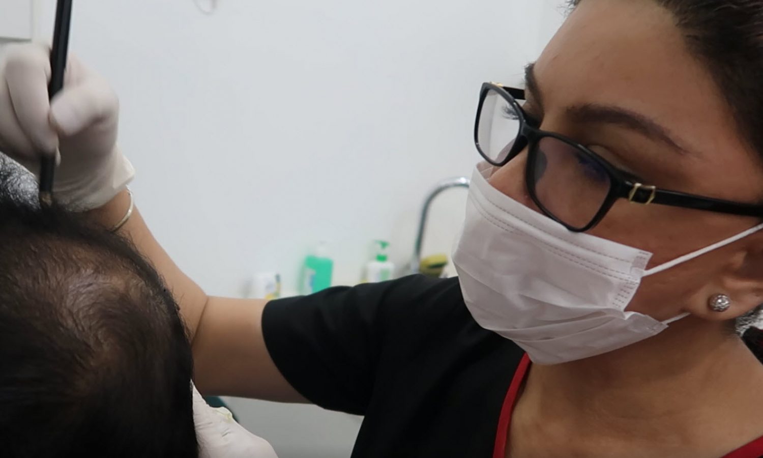 Hair Transplant FUE surgery For Crown Transplant Hair Transplant Malaysia-Crown Transplant