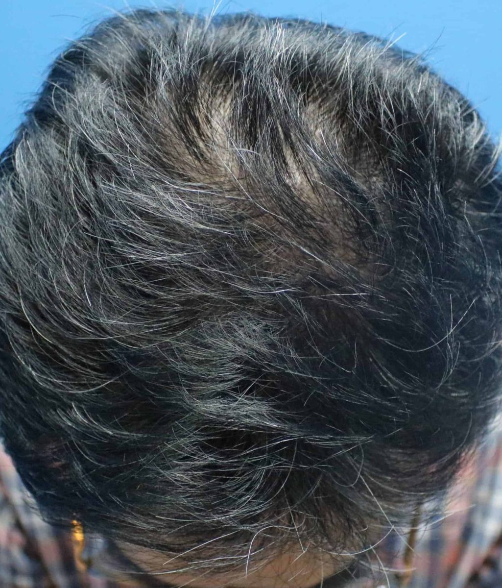 6 Month Result on Fue Hair Transplant
