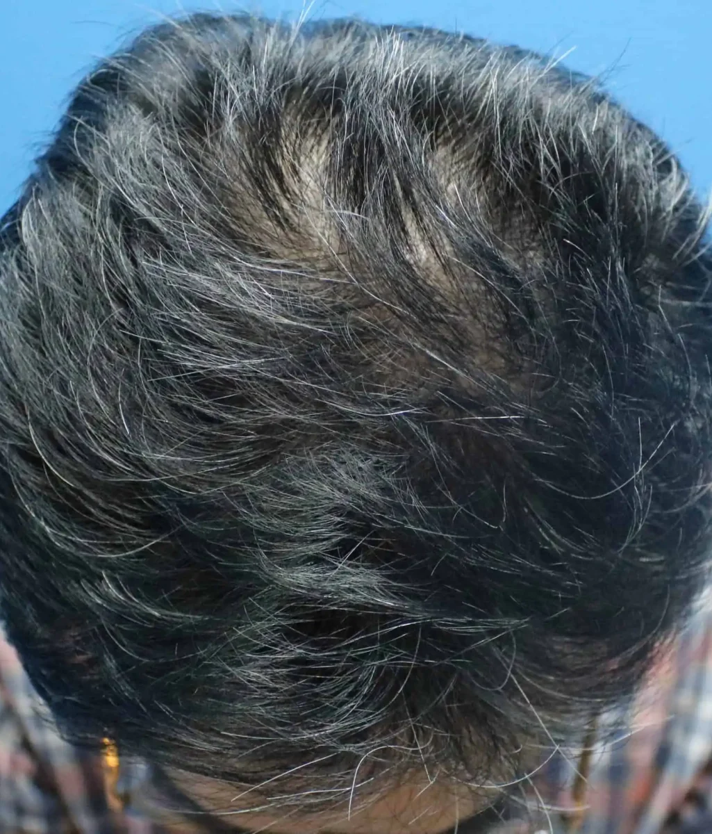 6 Month Result on Fue Hair Transplant