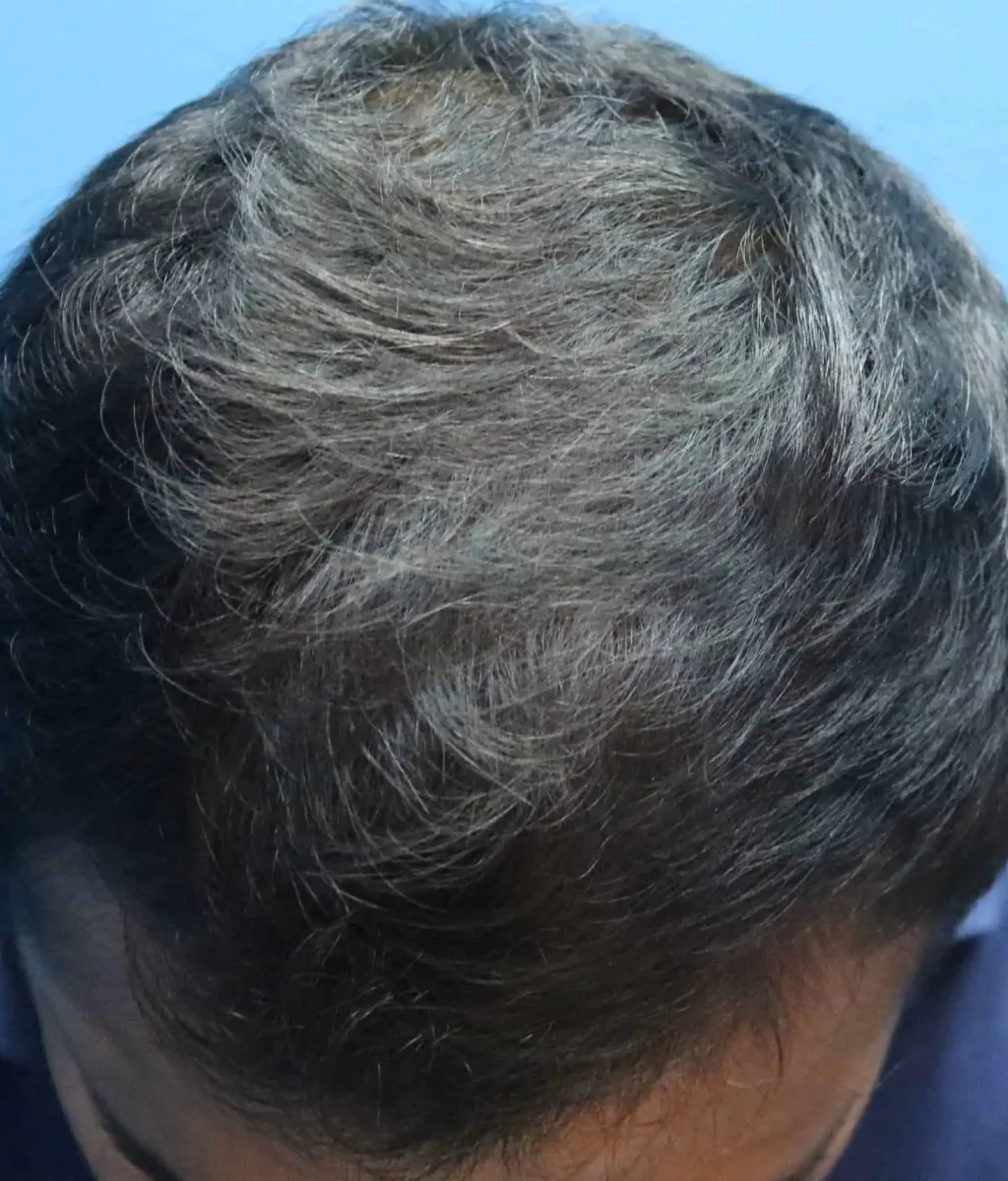 Fue Hair Transplant of 14 Month